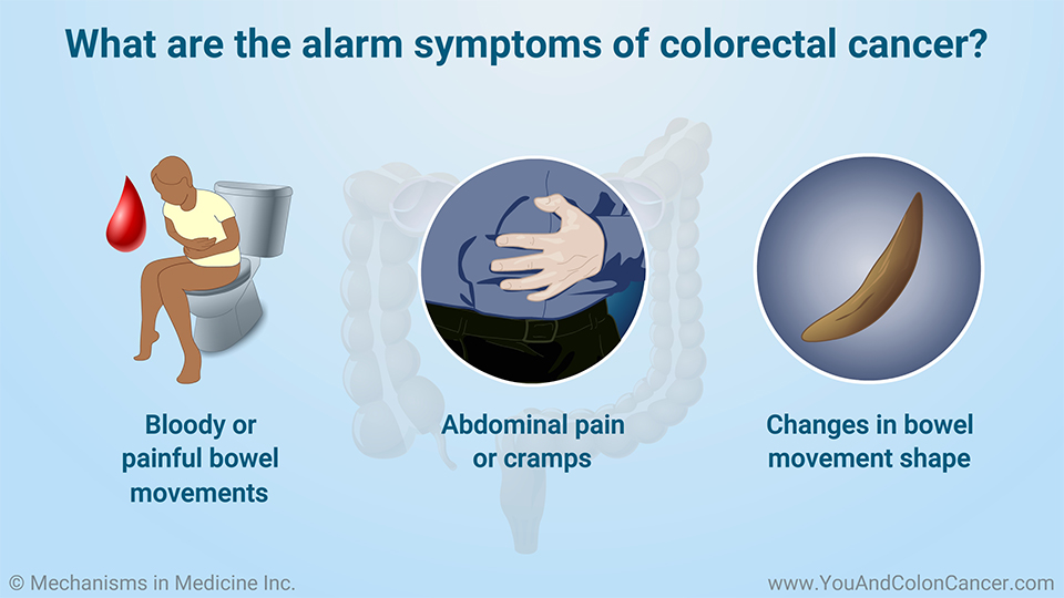 Slide Show What Are The Symptoms Of Colon Cancer